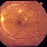 Background retinopathy. Punctate hemorrhage, pinpoint microaneurysms, exudates, with generalized macular edema